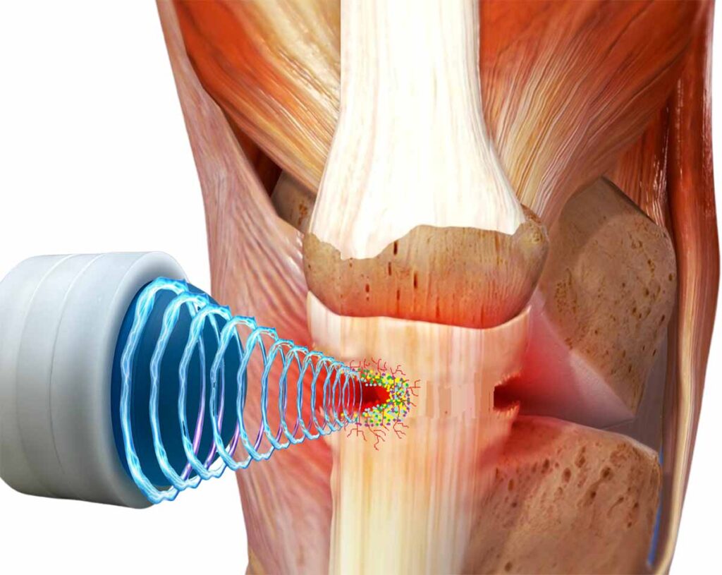 Illustration of knee receiving Shockwave Therapy at Atlas Peak in Pleasantville NY